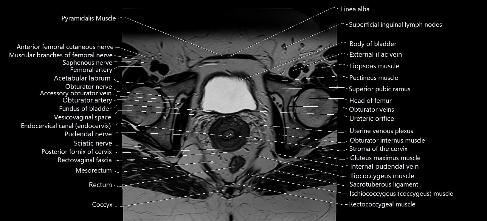 Axial cross sectional anatomy of female pelvis (MRI 3T) image 29.webp